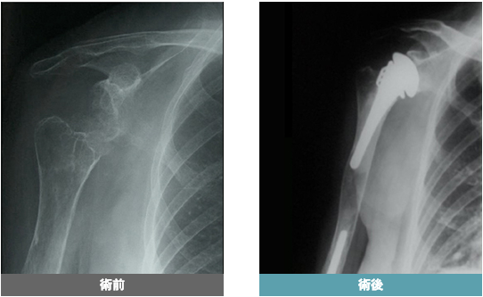 肩の人工骨頭を用いた関節形成術
