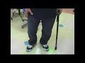 脊髄刺激療法（SCS）による痛みの変化（複合性局所疼痛症候群 No.1）▶動画